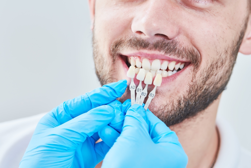 veneers-2