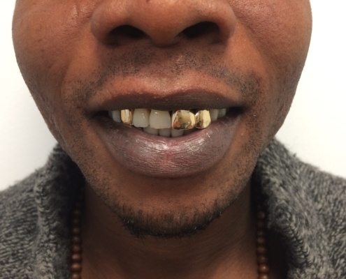 Zahnschmuck